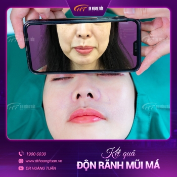 ĐỘN RÃNH MŨI MÁ